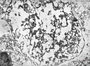 M,46y. | Entamoeba histolytica - intestine